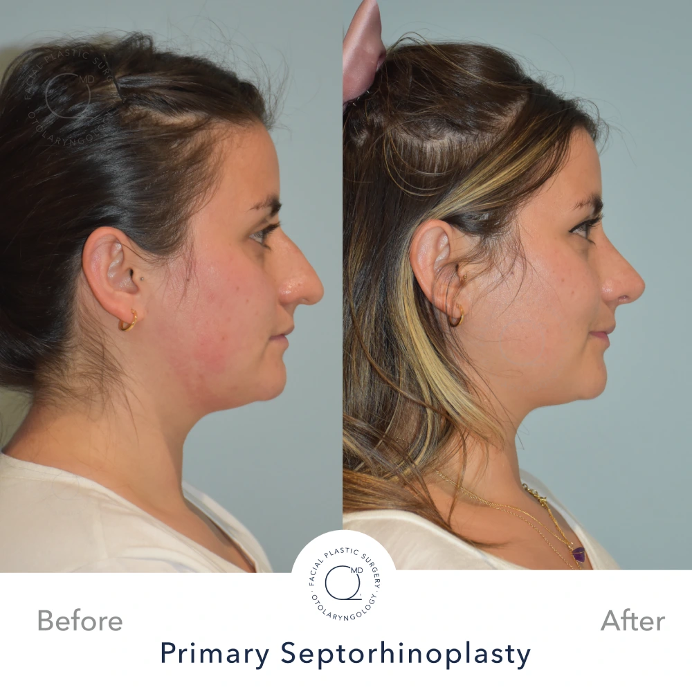 foto rinoplastia antes despues galeria