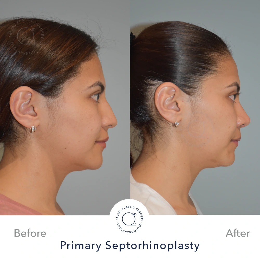 foto rinoplastia madrid antes caso 16