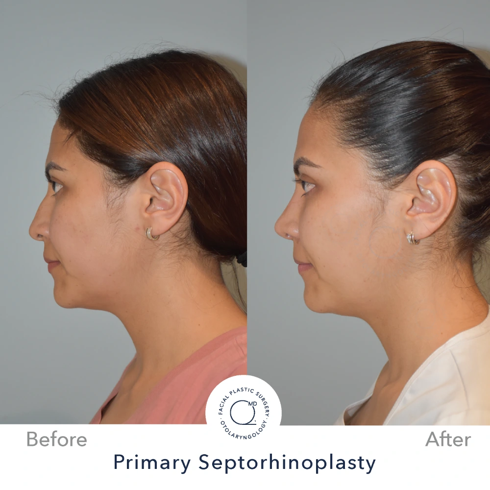 Foto rinoplastia Madrid caso 16