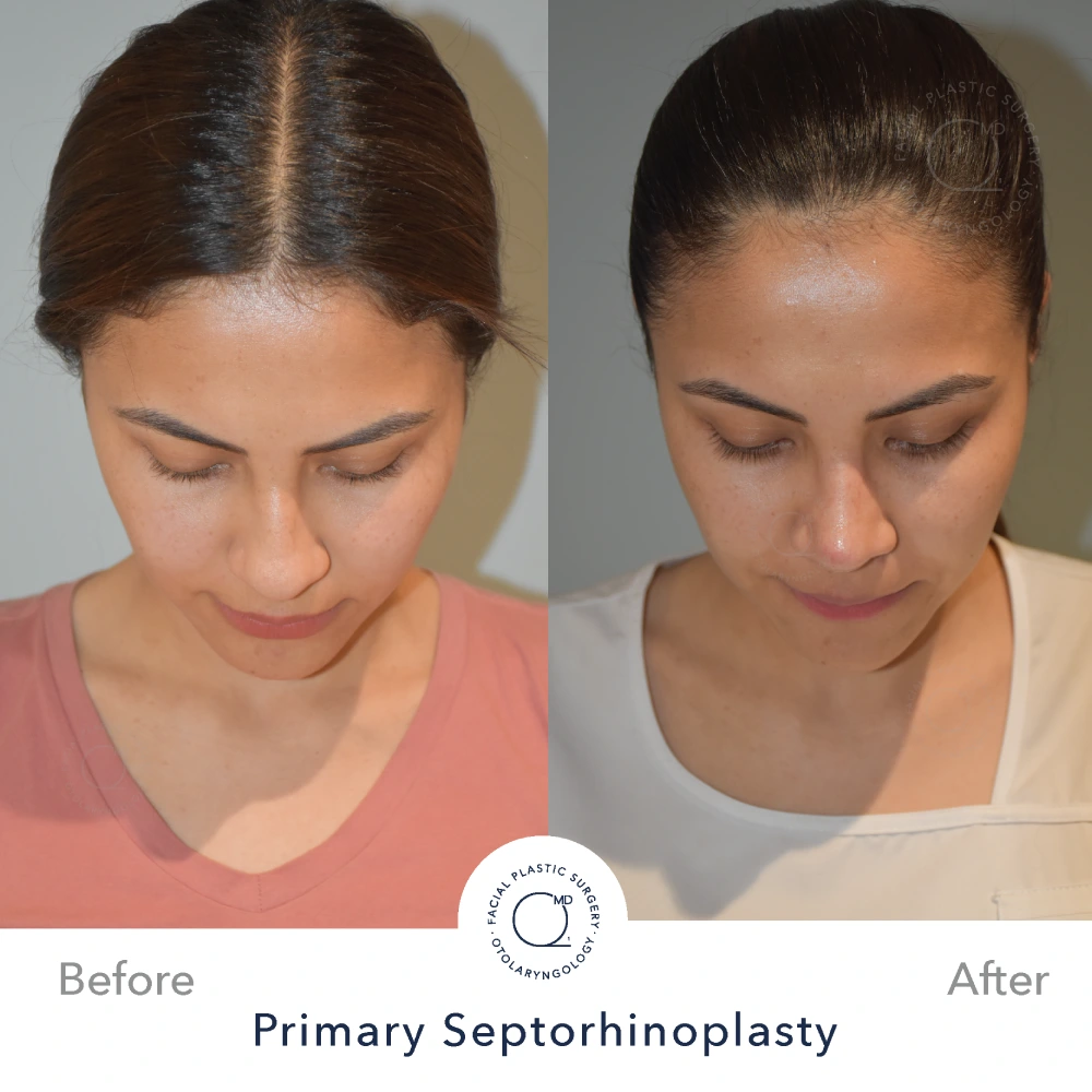 Foto rinoplastia Madrid Clinicas Duque 