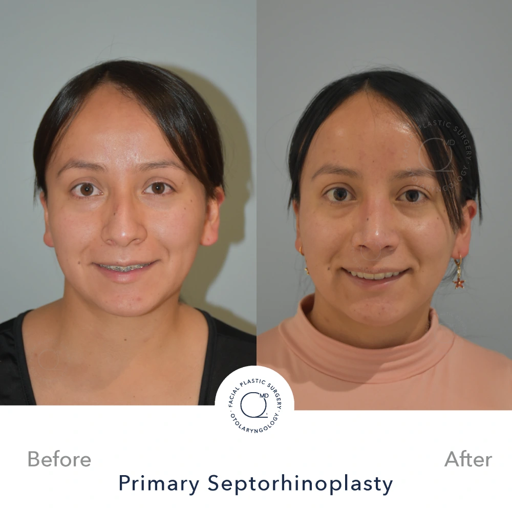 Foto rinoplastia Madrid despues caso 21