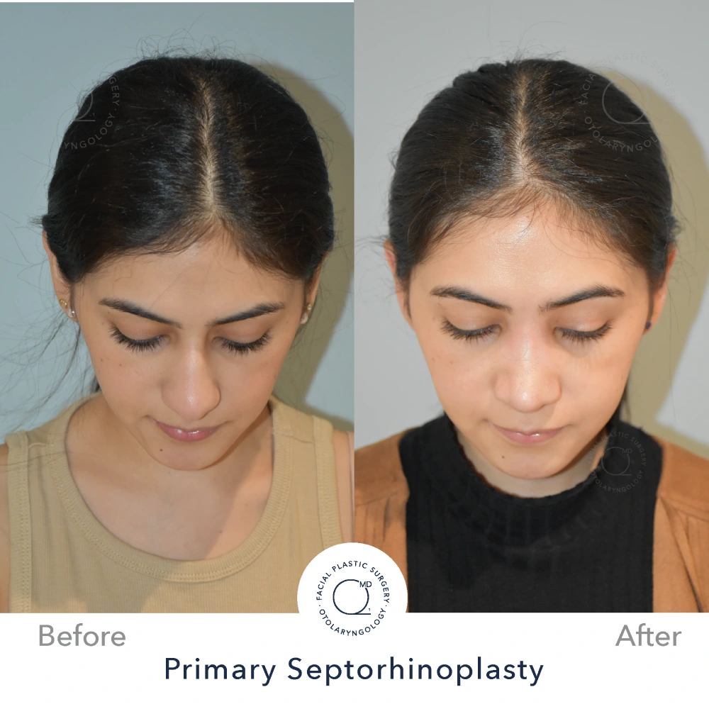 Foto rinoplastia Madrid perfil caso 14