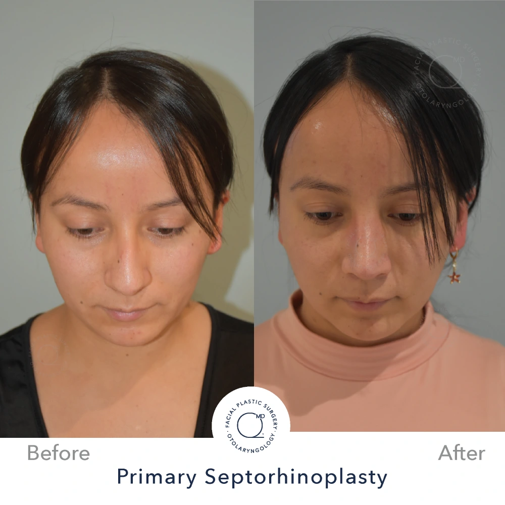 Foto rinoplastia Madrid perfil caso 21
