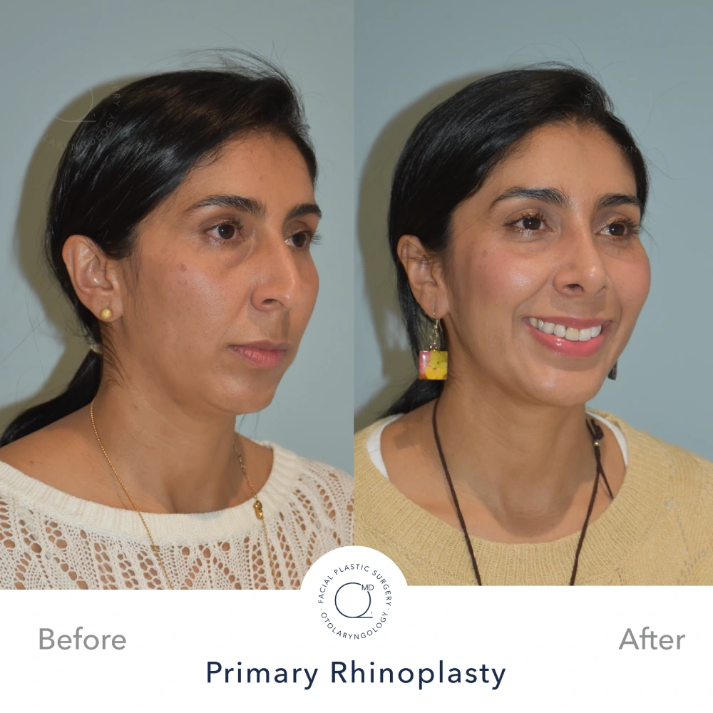 Foto rinoplastia Madrid perfil caso 6