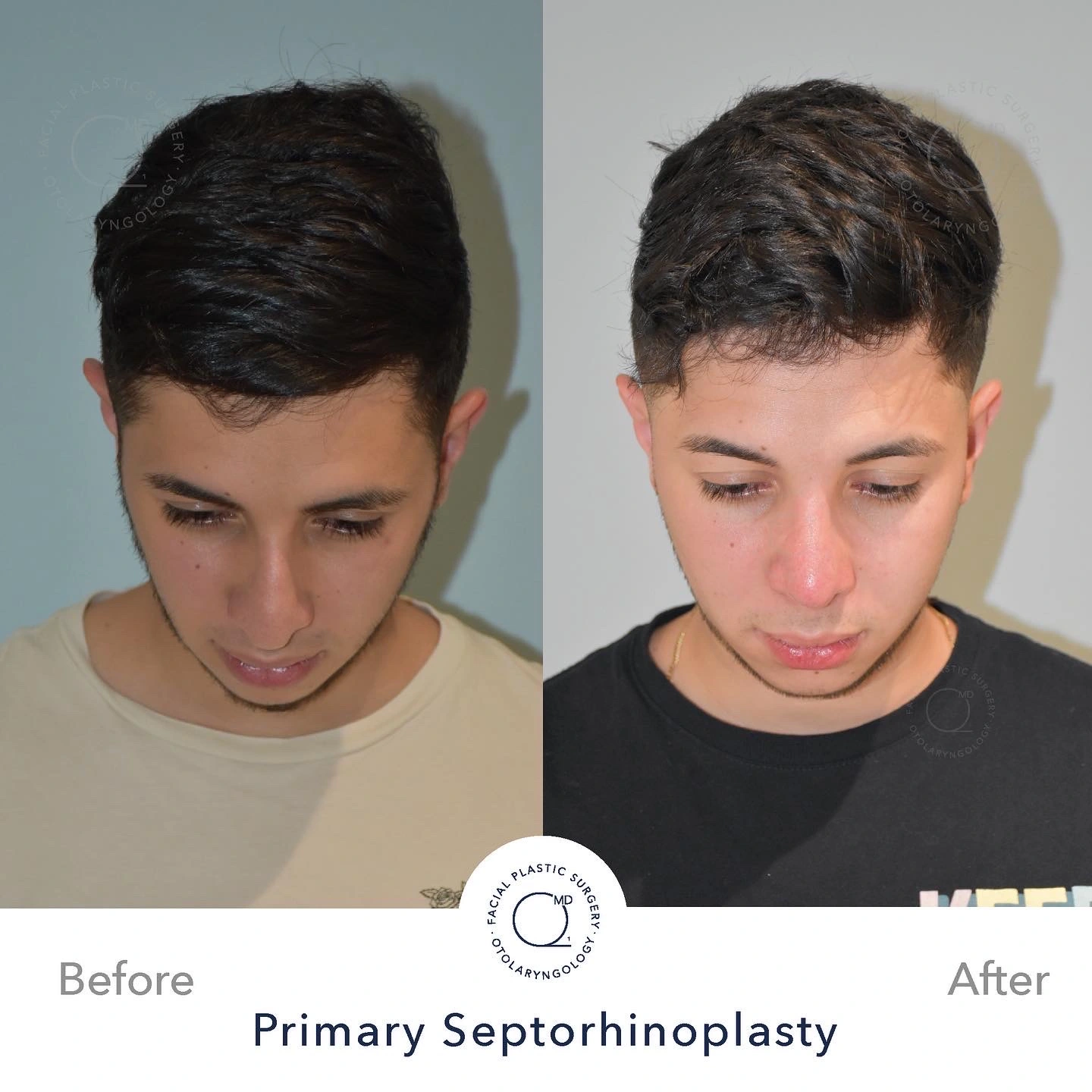 Foto rinoplastia Madrid perfil hombre