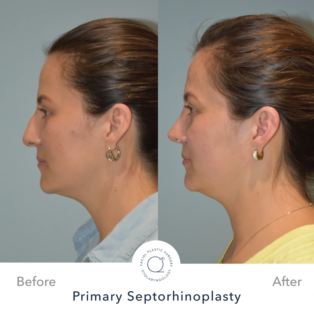 foto rinoplastia mujer antes