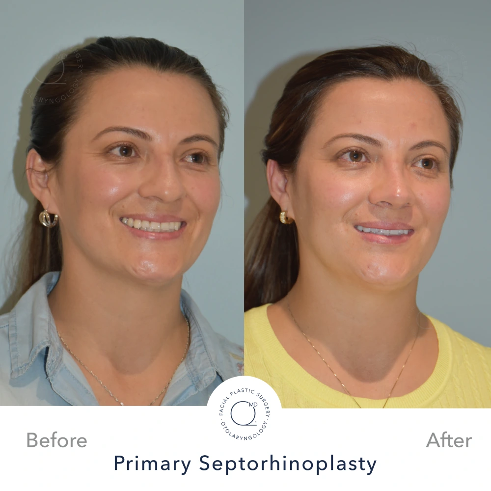 rinoplastia foto mujer antes