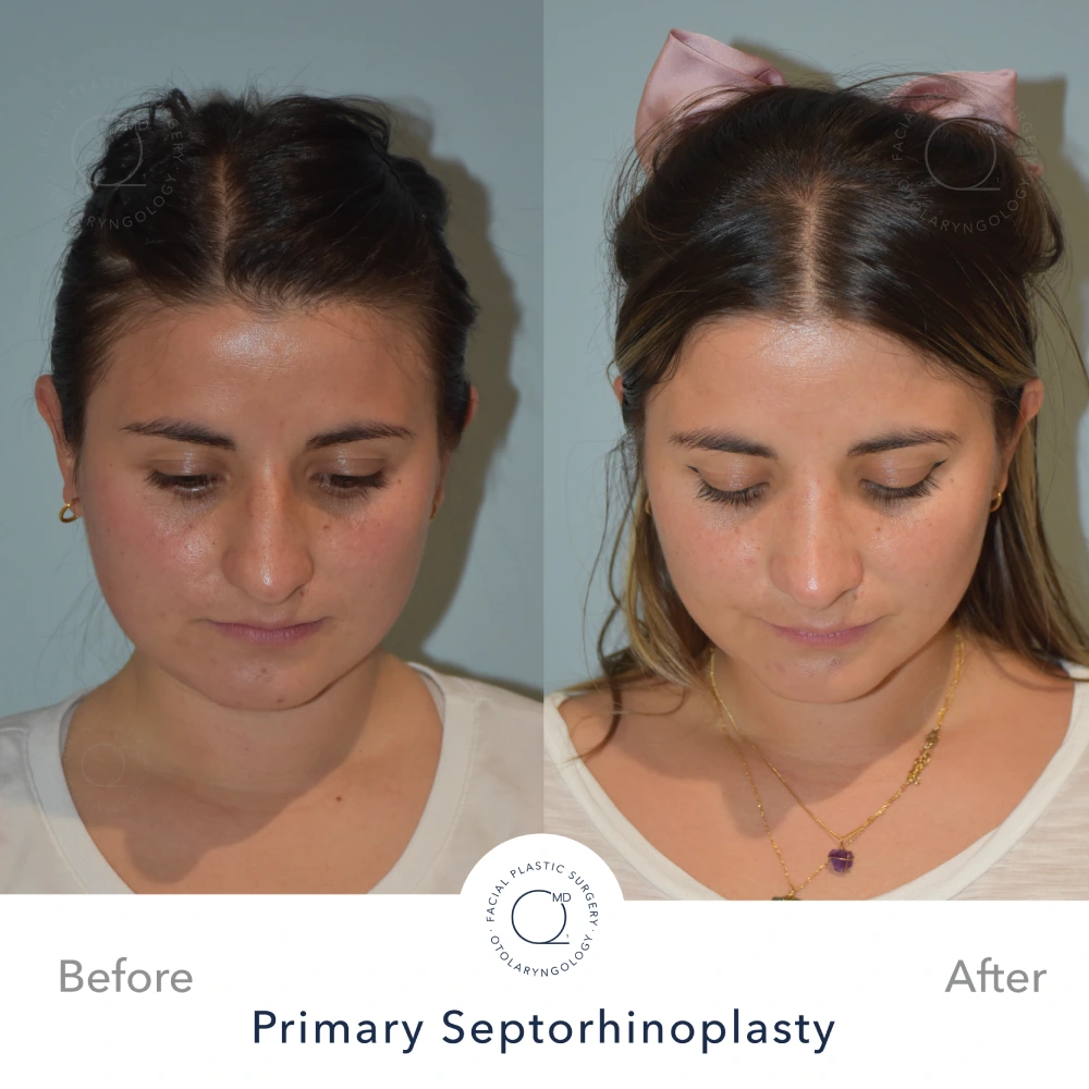 rinoplastia foto perfil despues