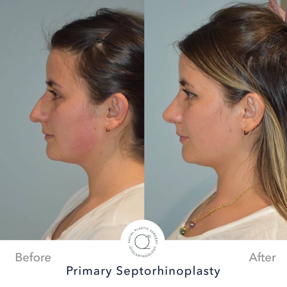 rinoplastia Madrid foto