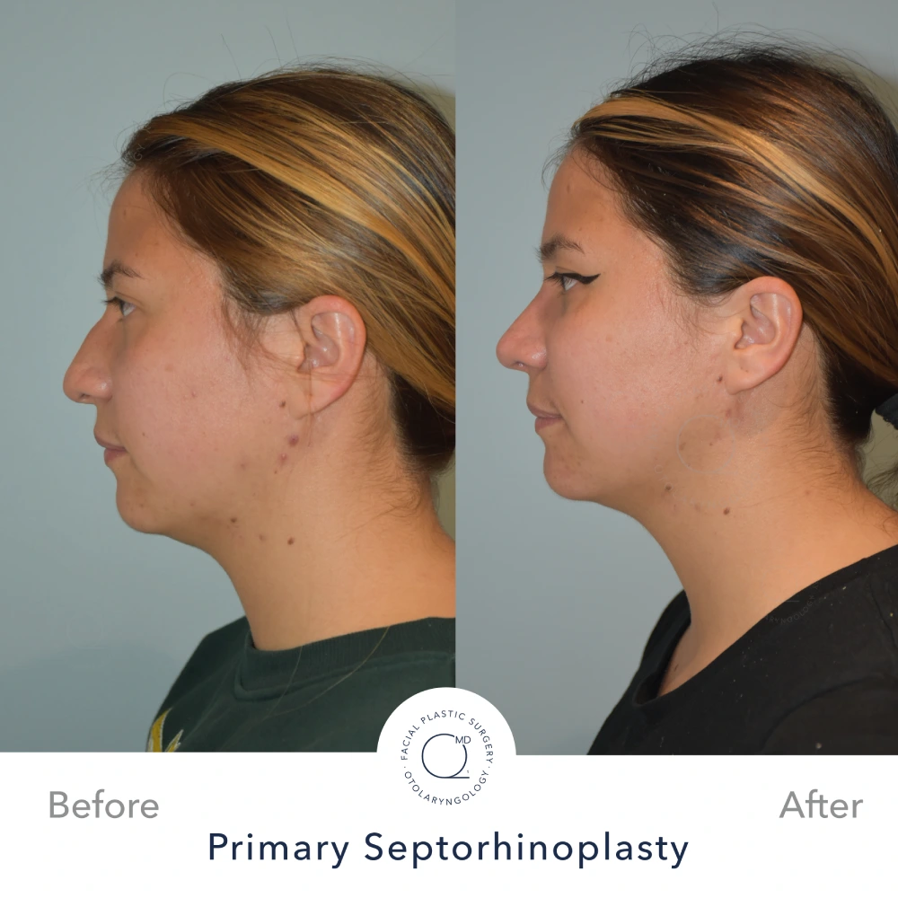 Rinoplastia perfil foto