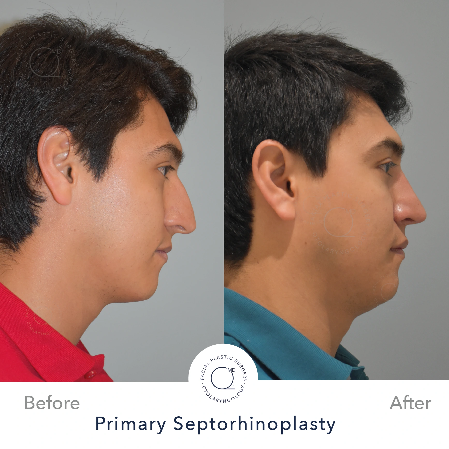 Foto rinoplastia caso 22