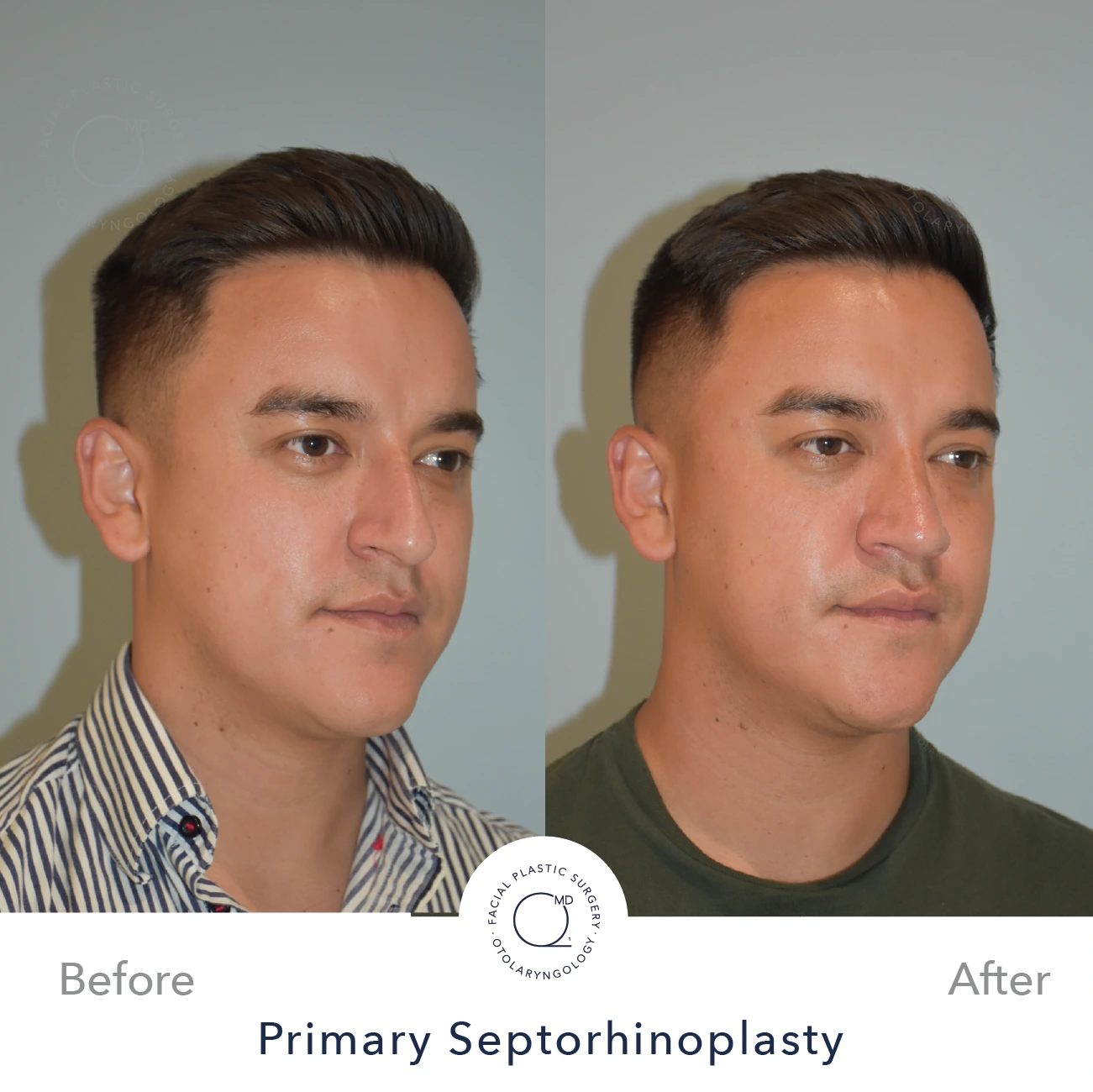 Foto rinoplastia despues Madrid caso 24