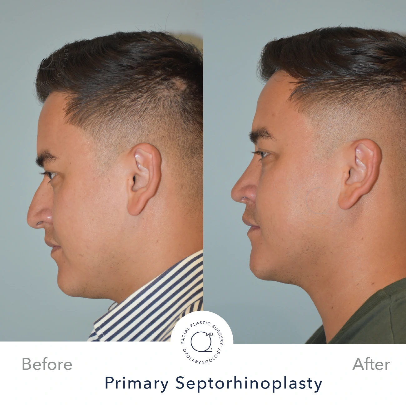 Foto rinoplastia Madrid antes caso 24