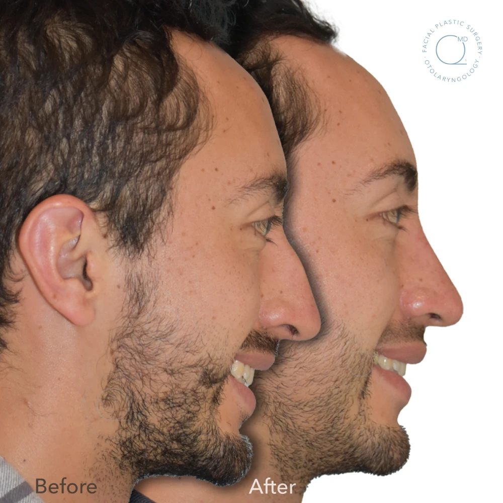 Foto-rinoplastia-madrid-caso-28