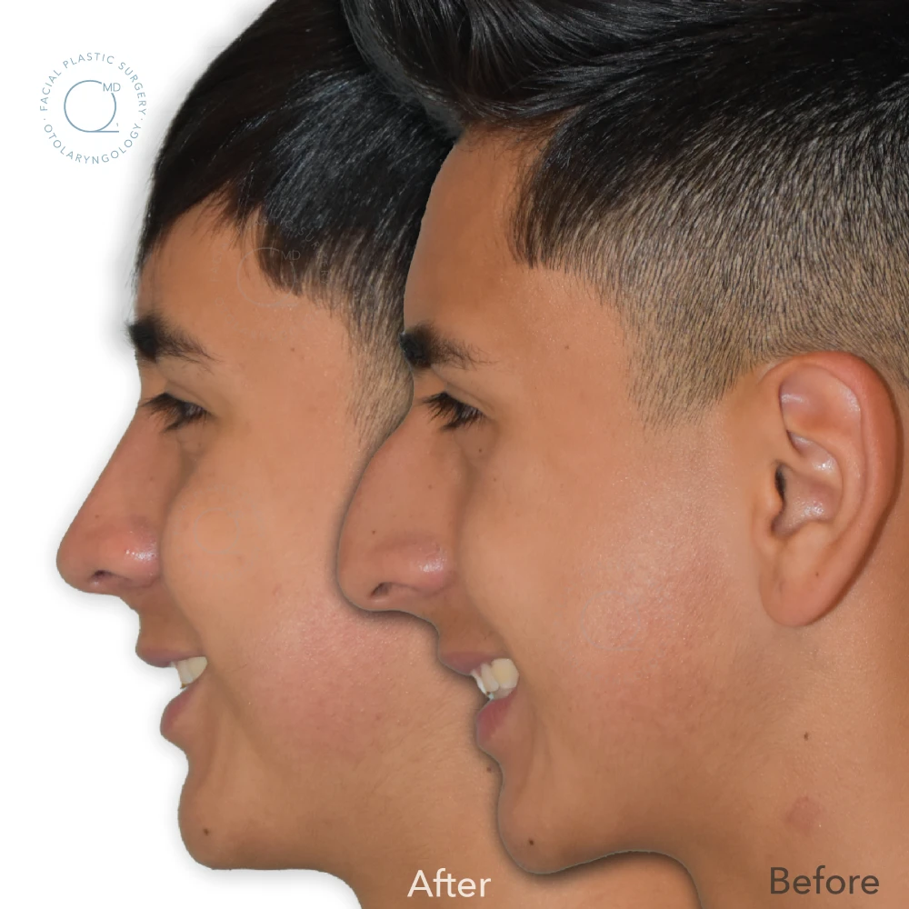 foto-rinoplastia-madrid-caso-29