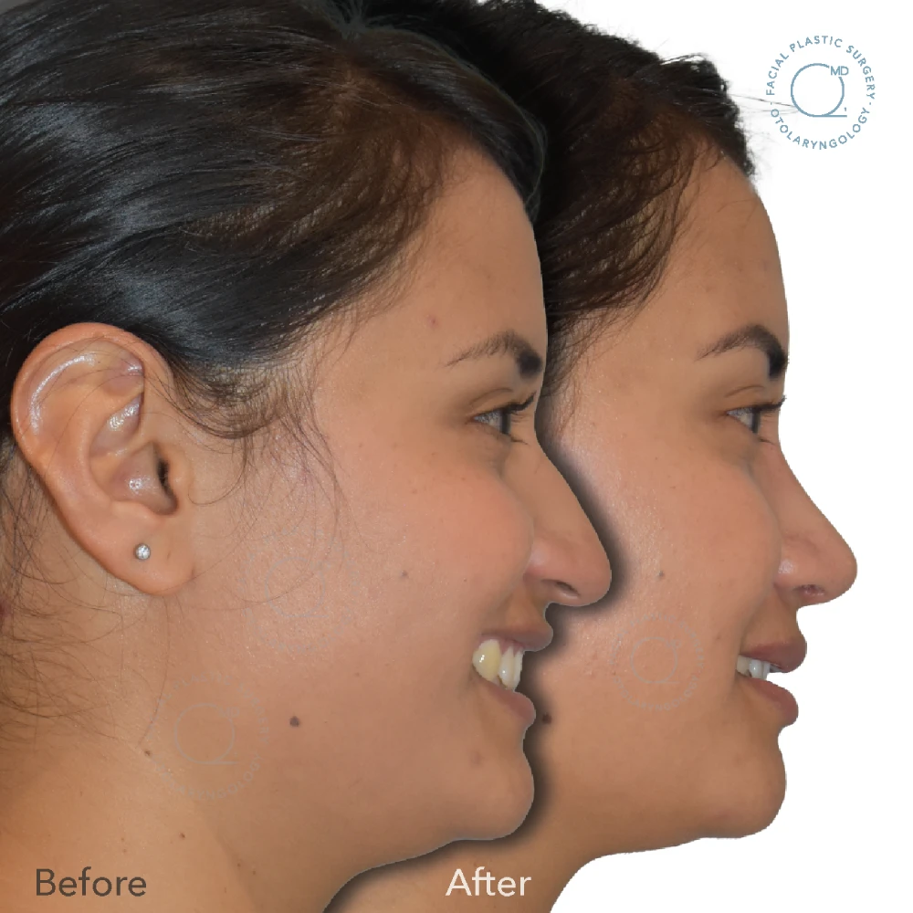 foto-rinoplastia-madrid-caso-30