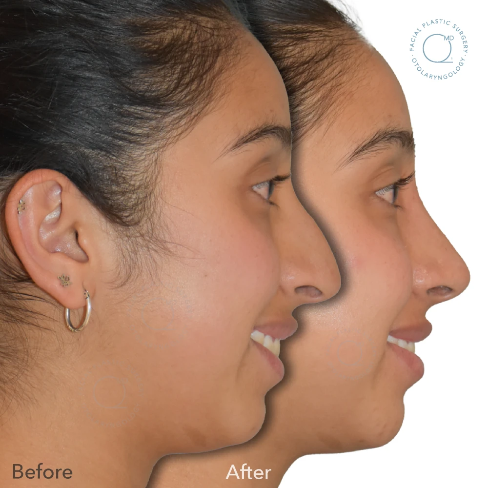 foto-rinoplastia-madrid-caso-31