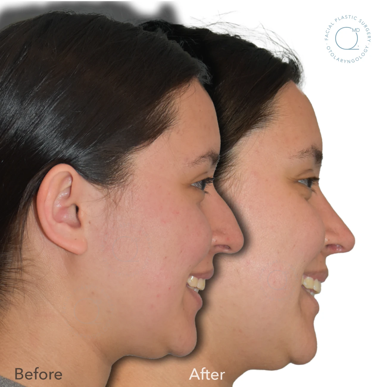 foto-rinoplastia-madrid-caso-33