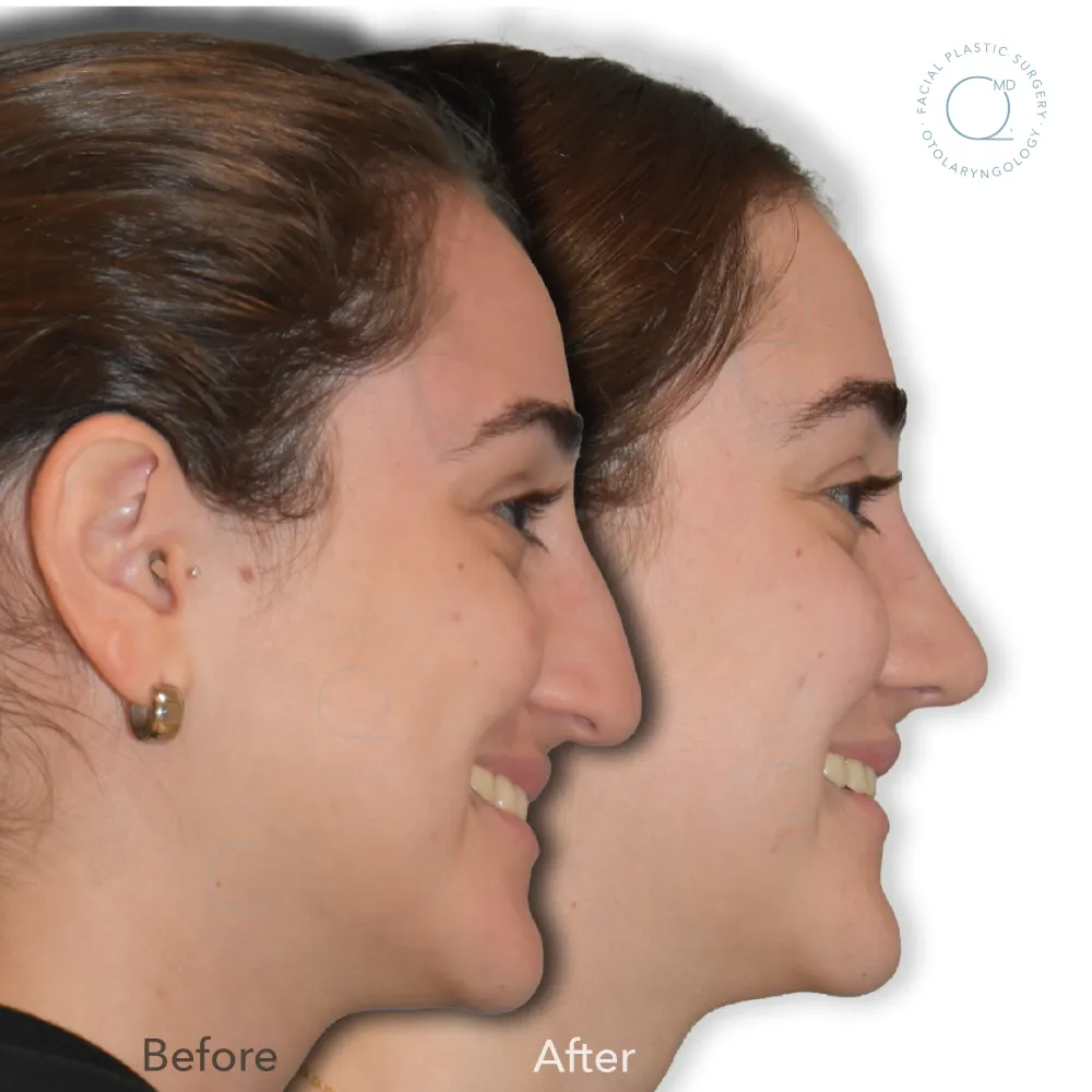 foto-rinoplastia-madrid-caso-34