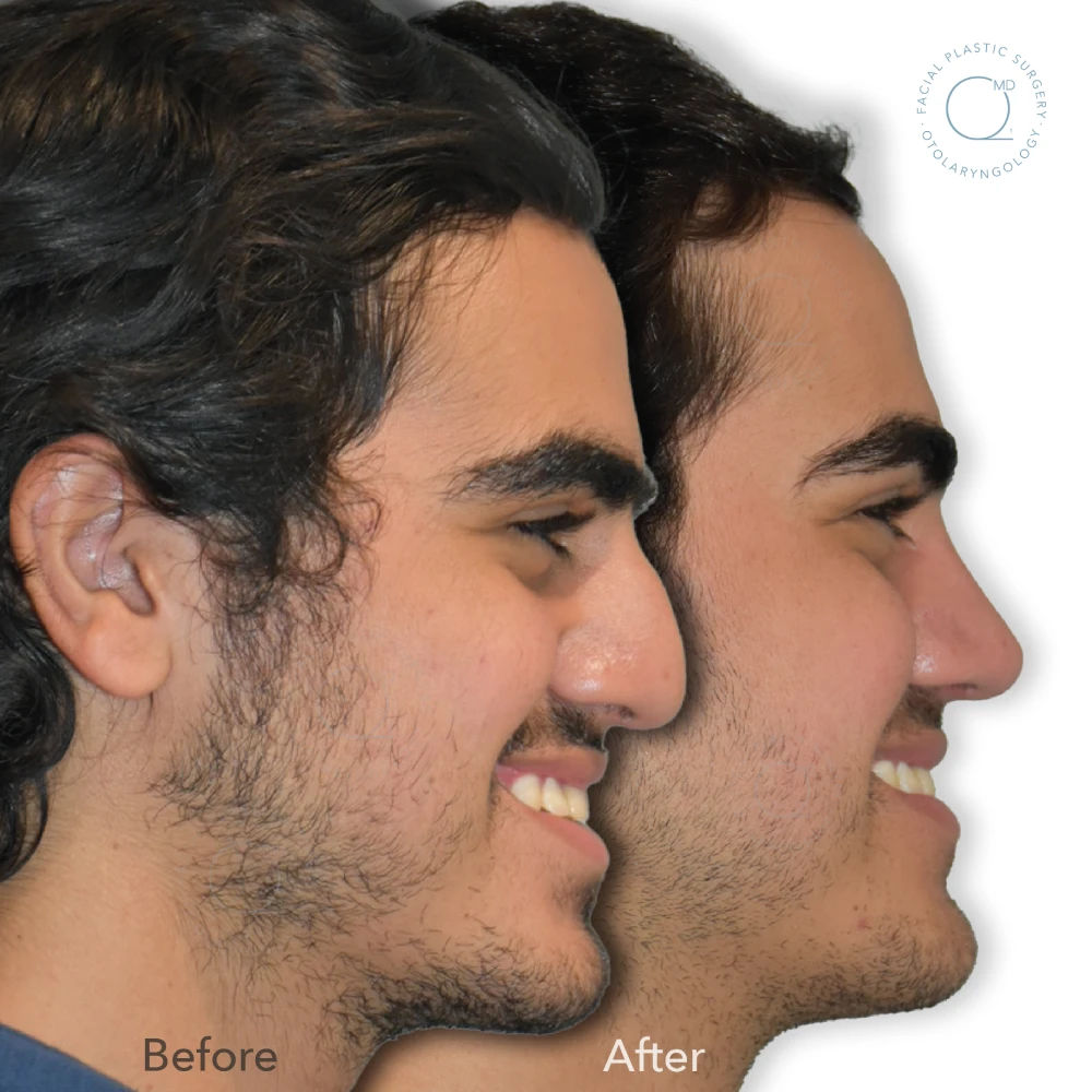 foto-rinoplastia-madrid-caso-36