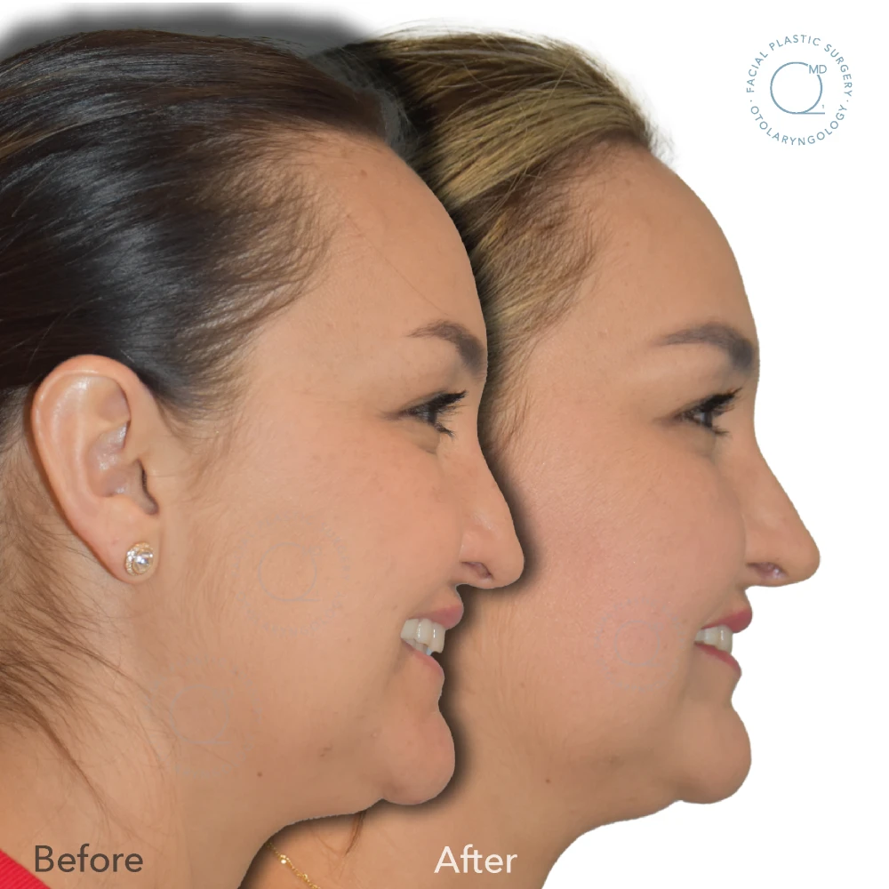 foto-rinoplastia-madrid-caso-37