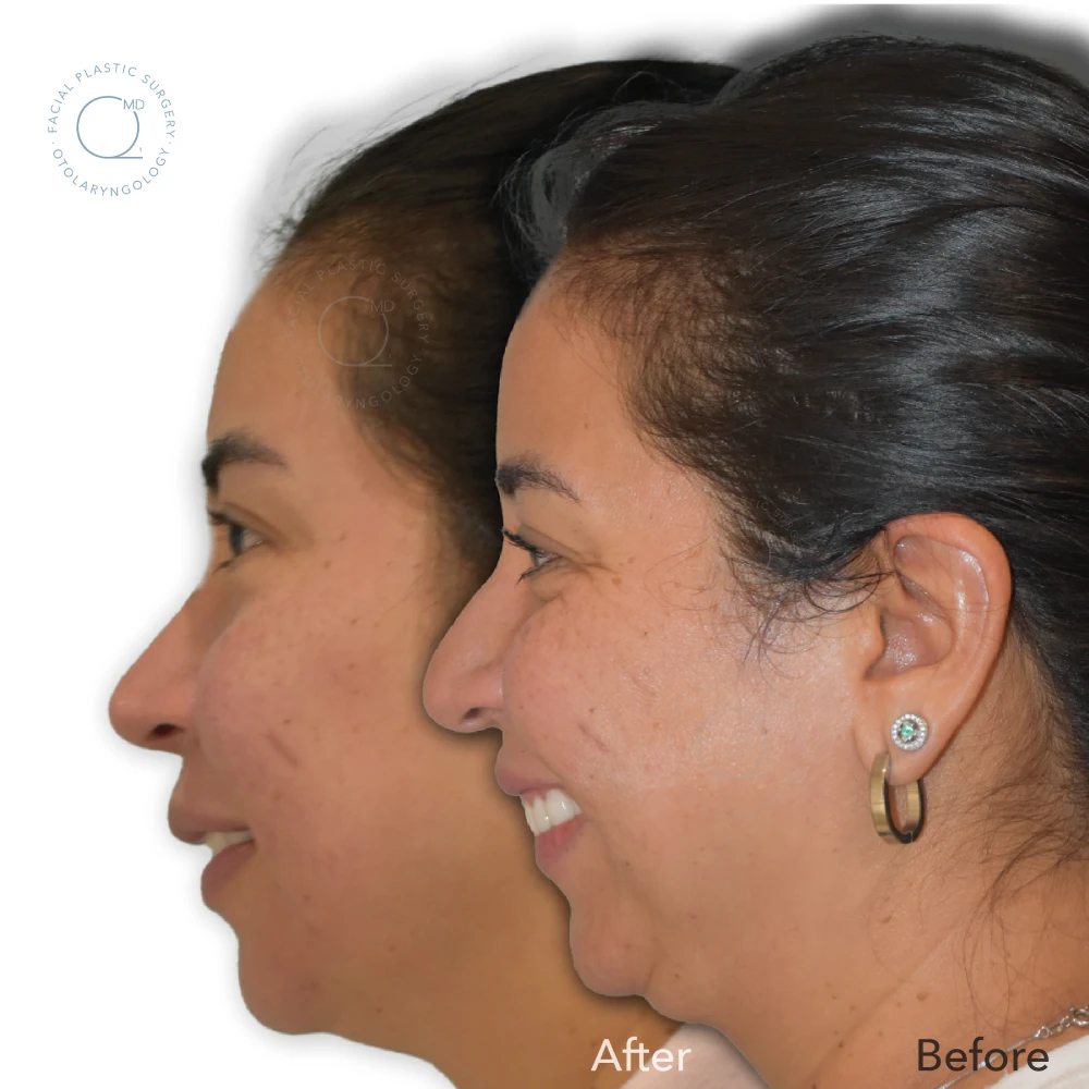 foto-rinoplastia-madrid-caso-38