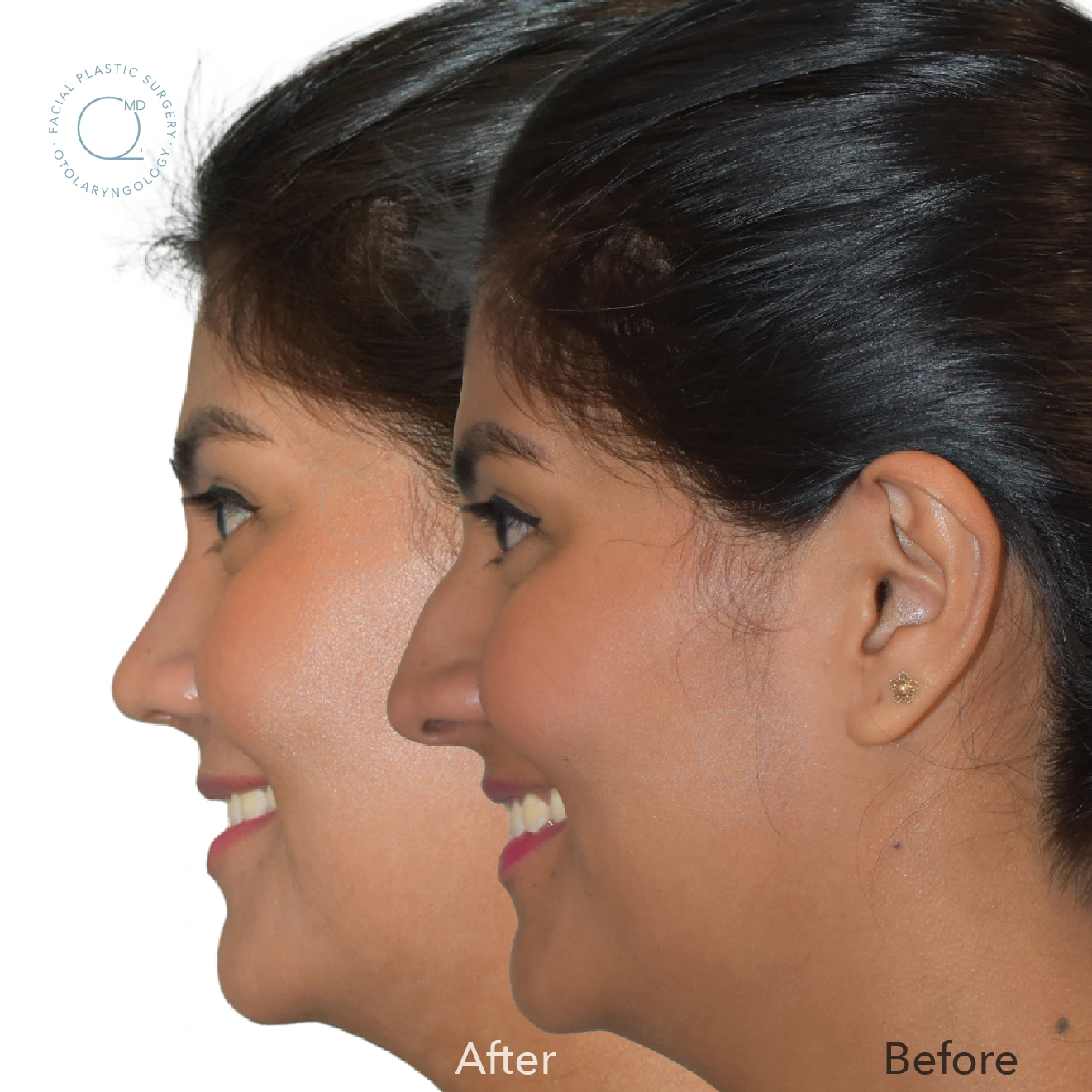 Foto rinoplastia Madrid caso 23