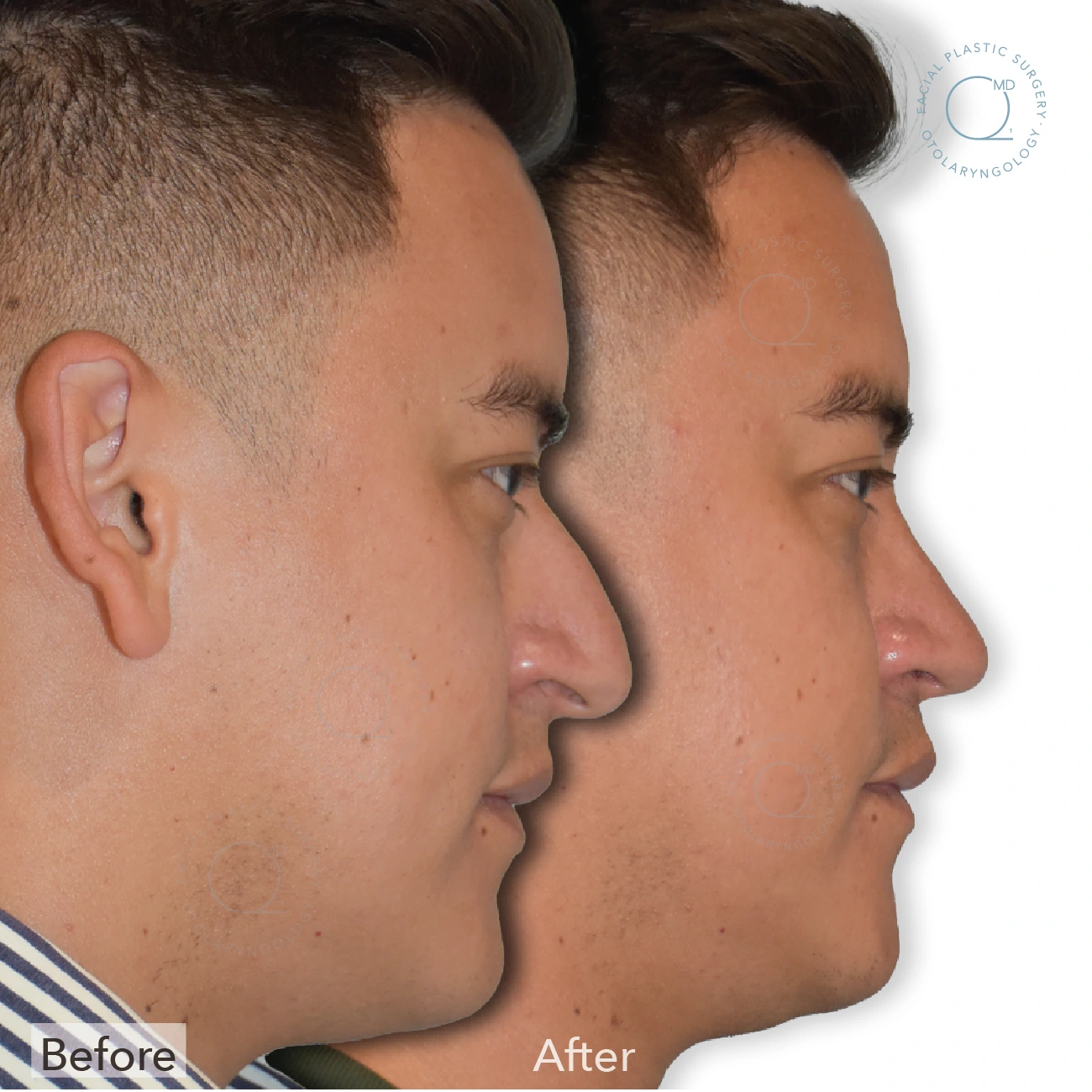 Foto rinoplastia Madrid caso 24