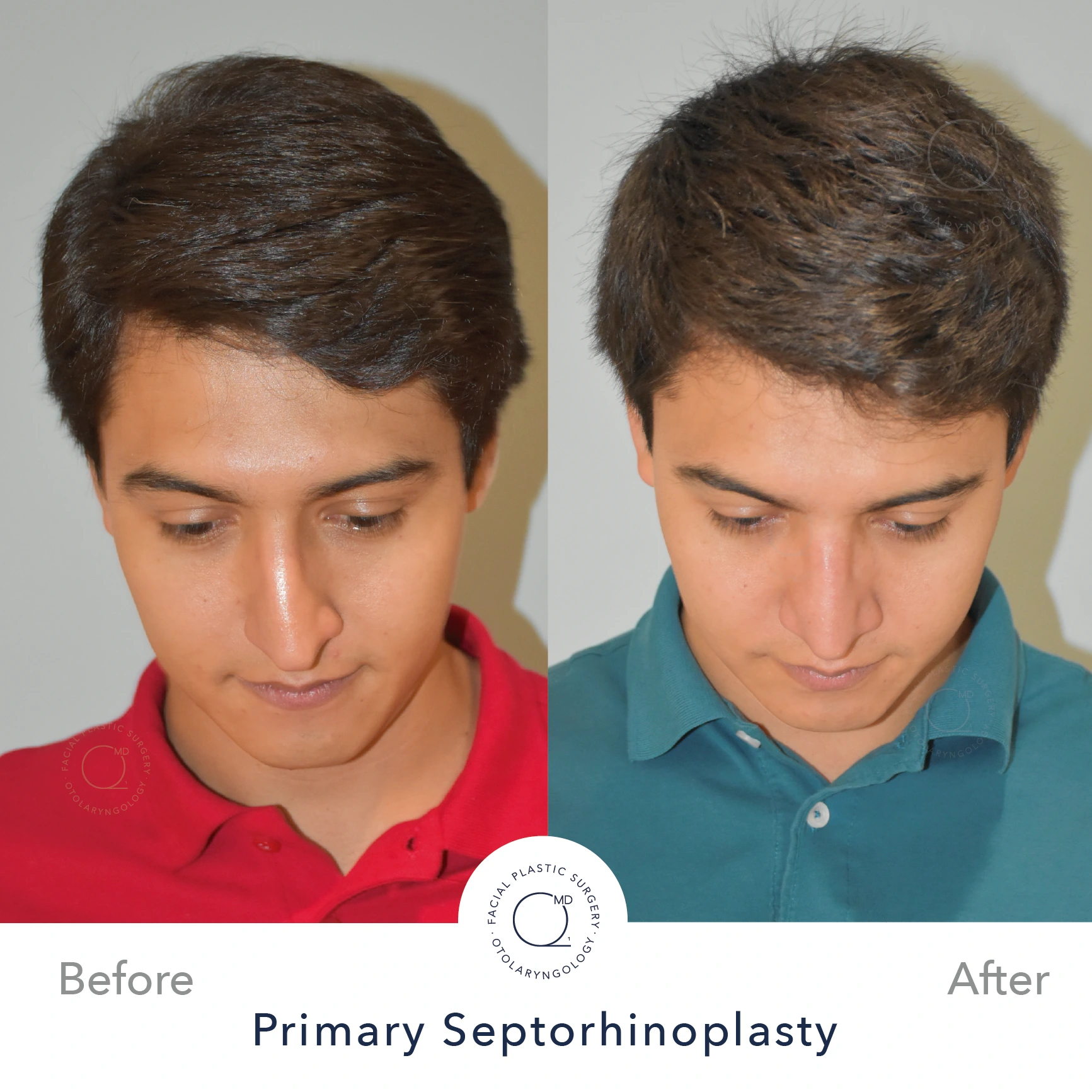 Foto rinoplastia Madrid despues caso 22