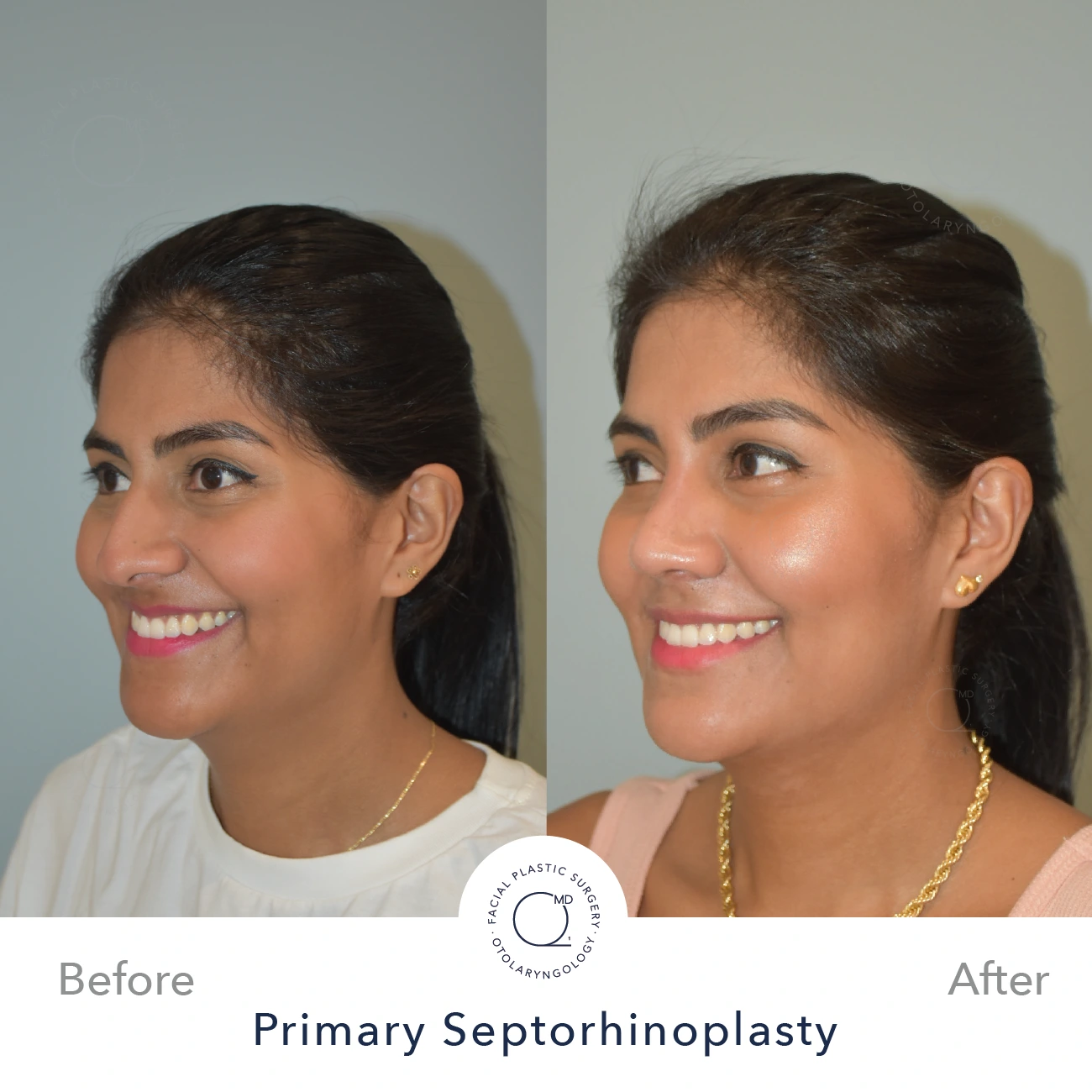 Foto rinoplastia Madrid despues caso 23