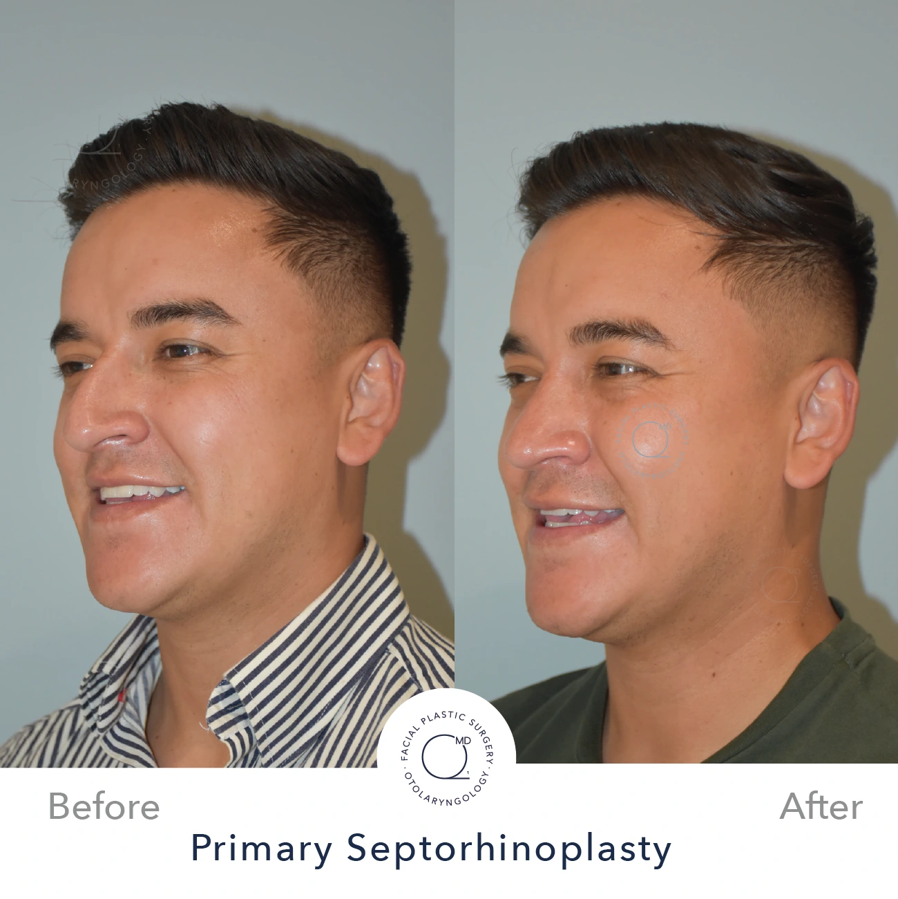 Foto rinoplastia madrid despues caso 4