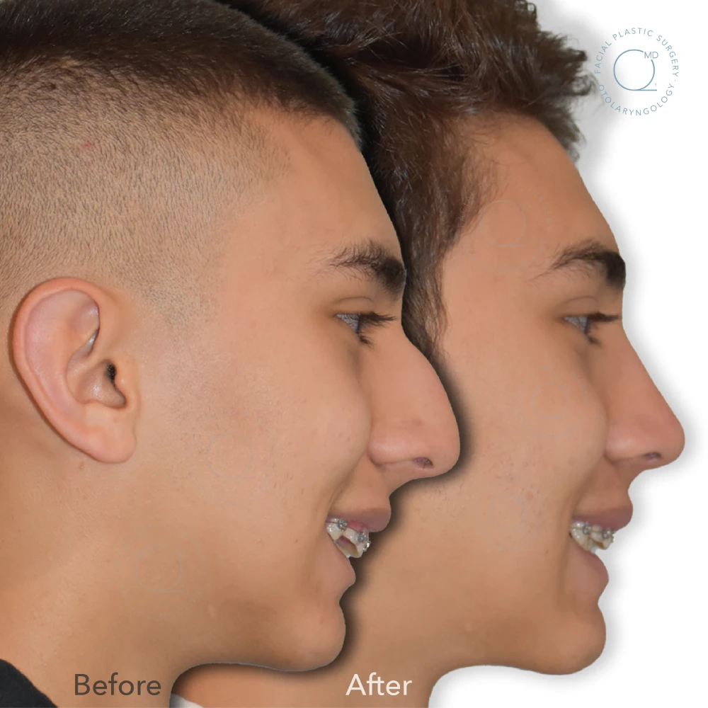 rinoplastia foto antes caso25 madrid