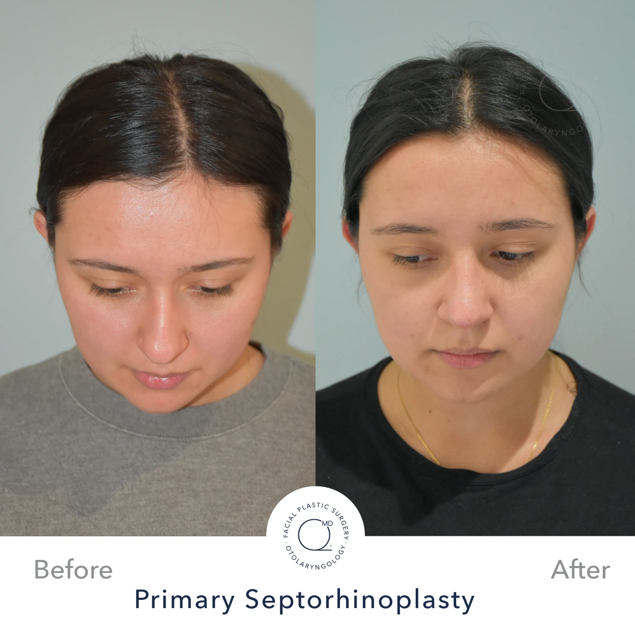 rinoplastia-foto-caso-33