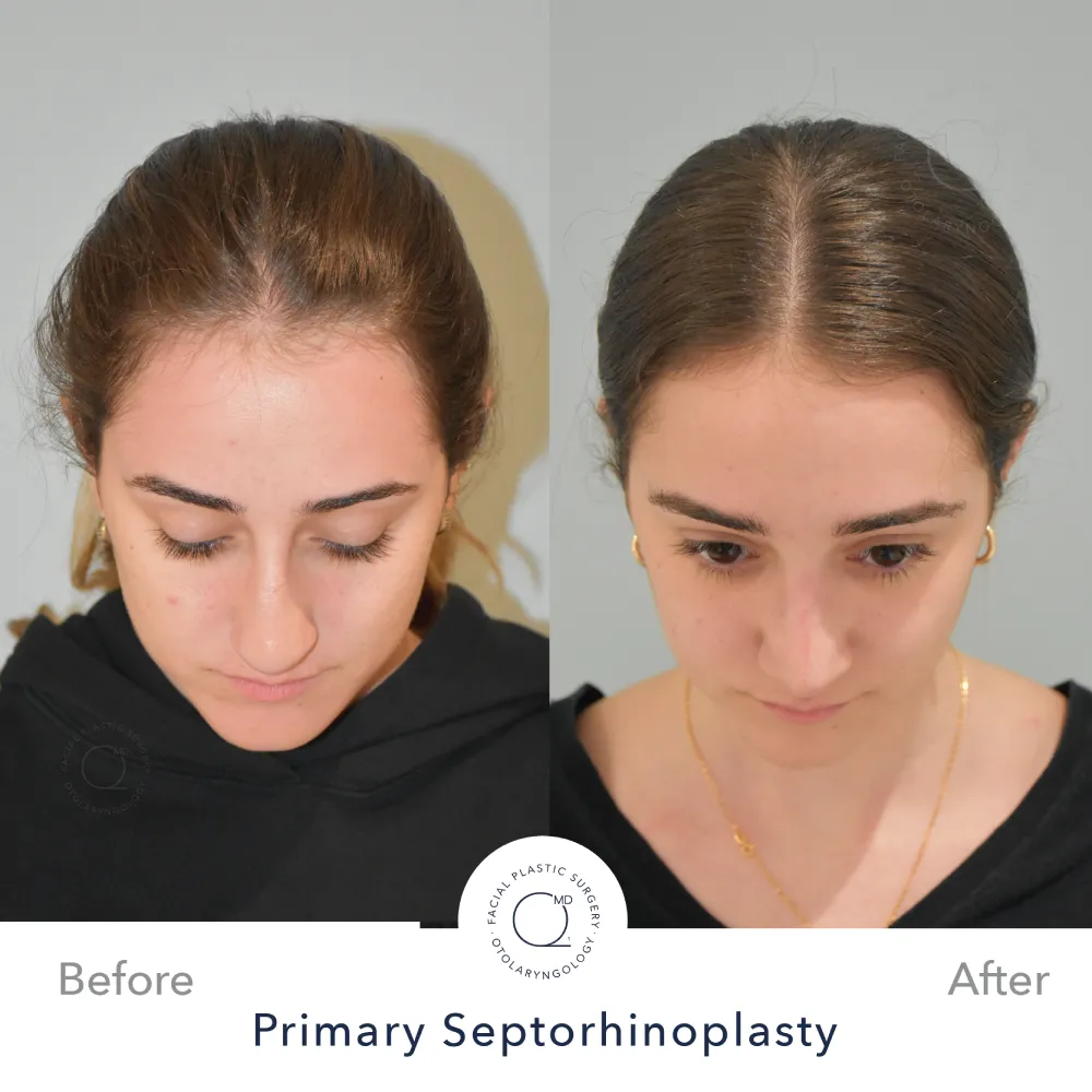 rinoplastia-foto-caso-34