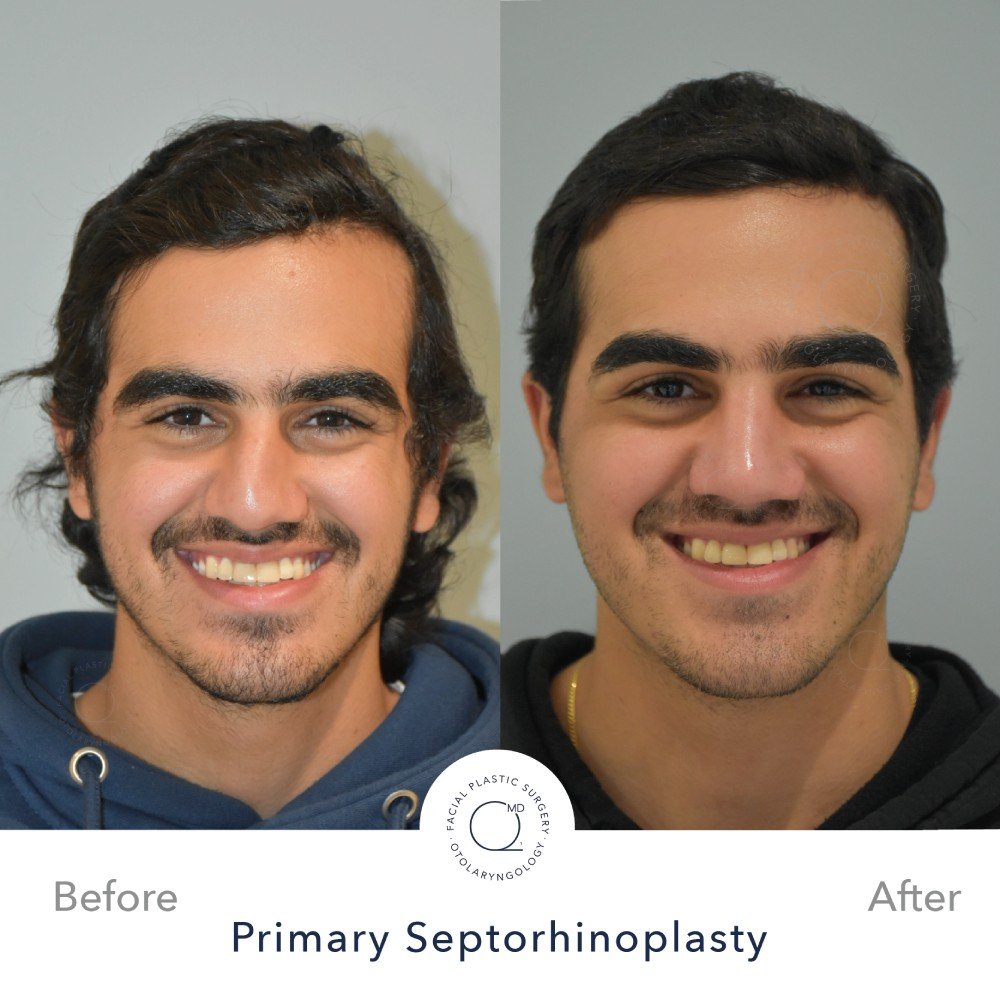 rinoplastia-foto-caso-36