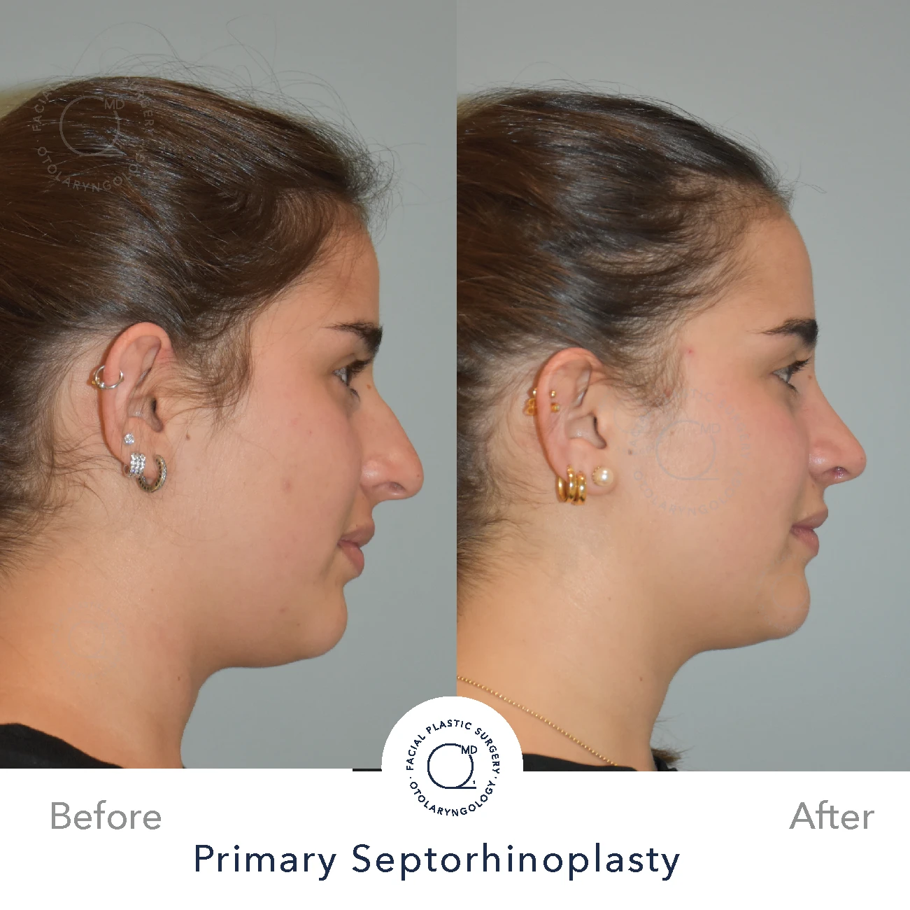 rinoplastia caso 27