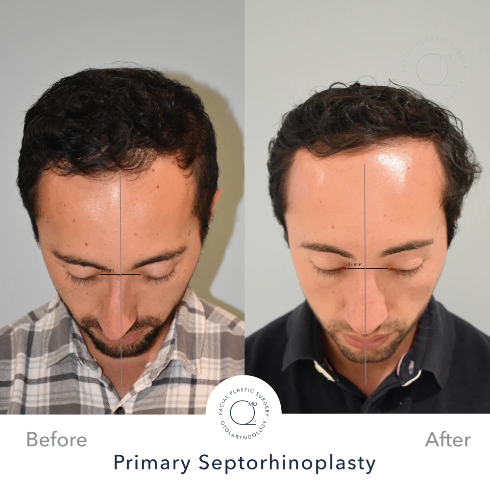 rinoplastia-foto-despues-mujer-caso-28