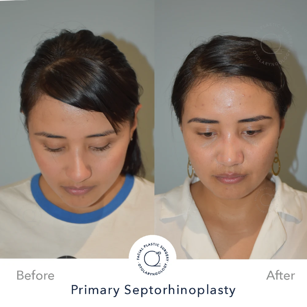 rinoplastia-foto-despues-mujer-caso-30