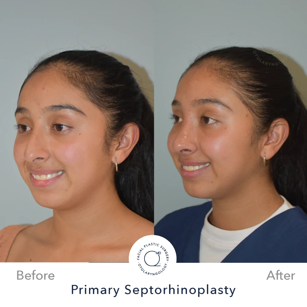 rinoplastia-foto-despues-mujer-caso-31