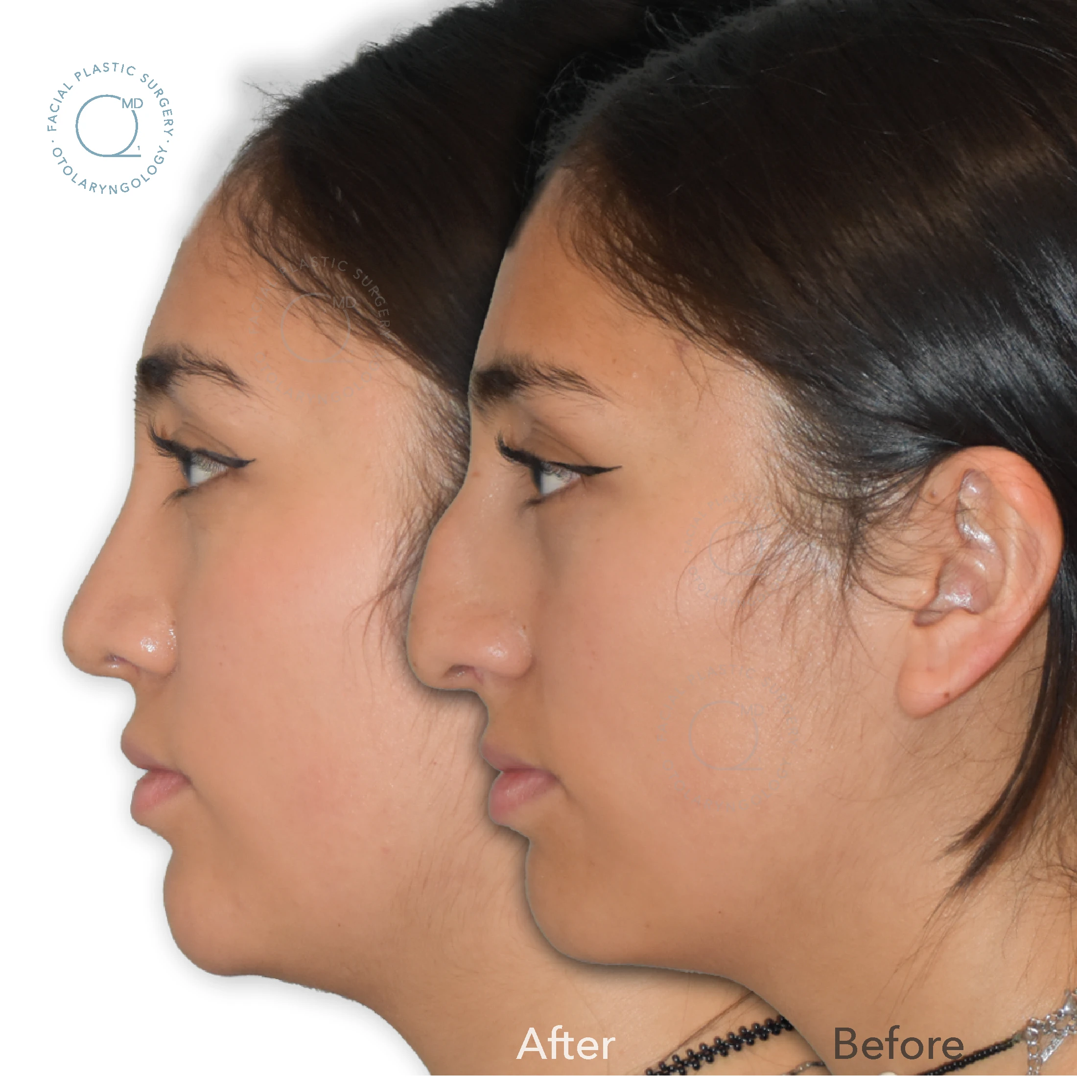 Rinoplastia mujer caso 26