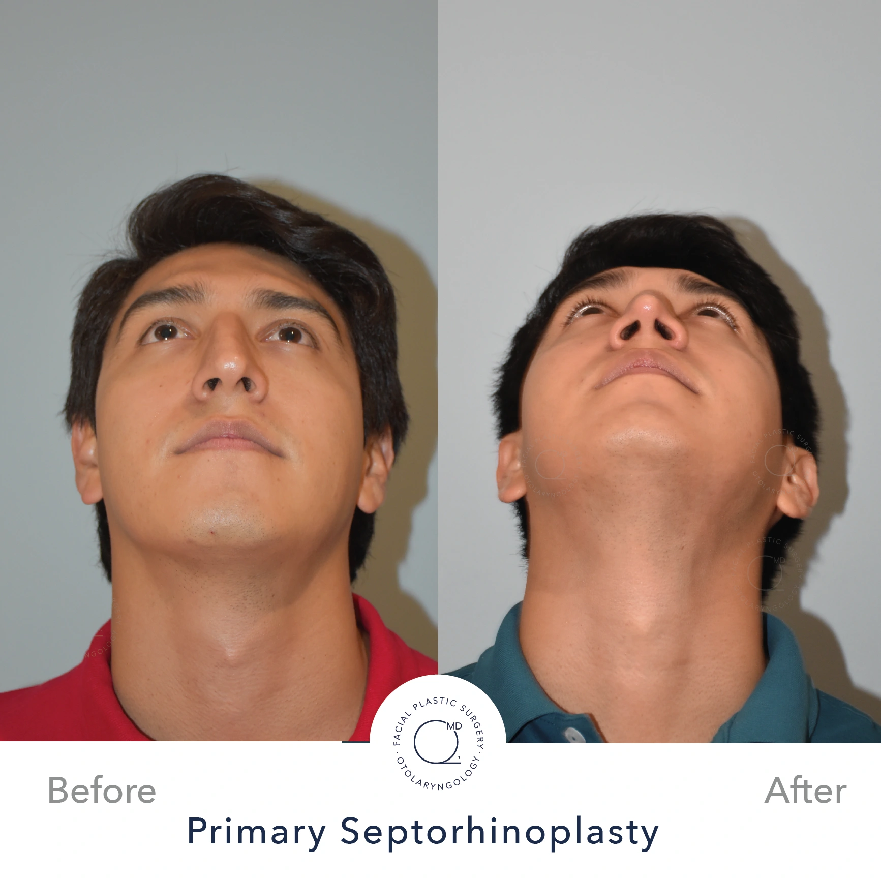 Rinoplastia foto Madrid  perfil caso 22