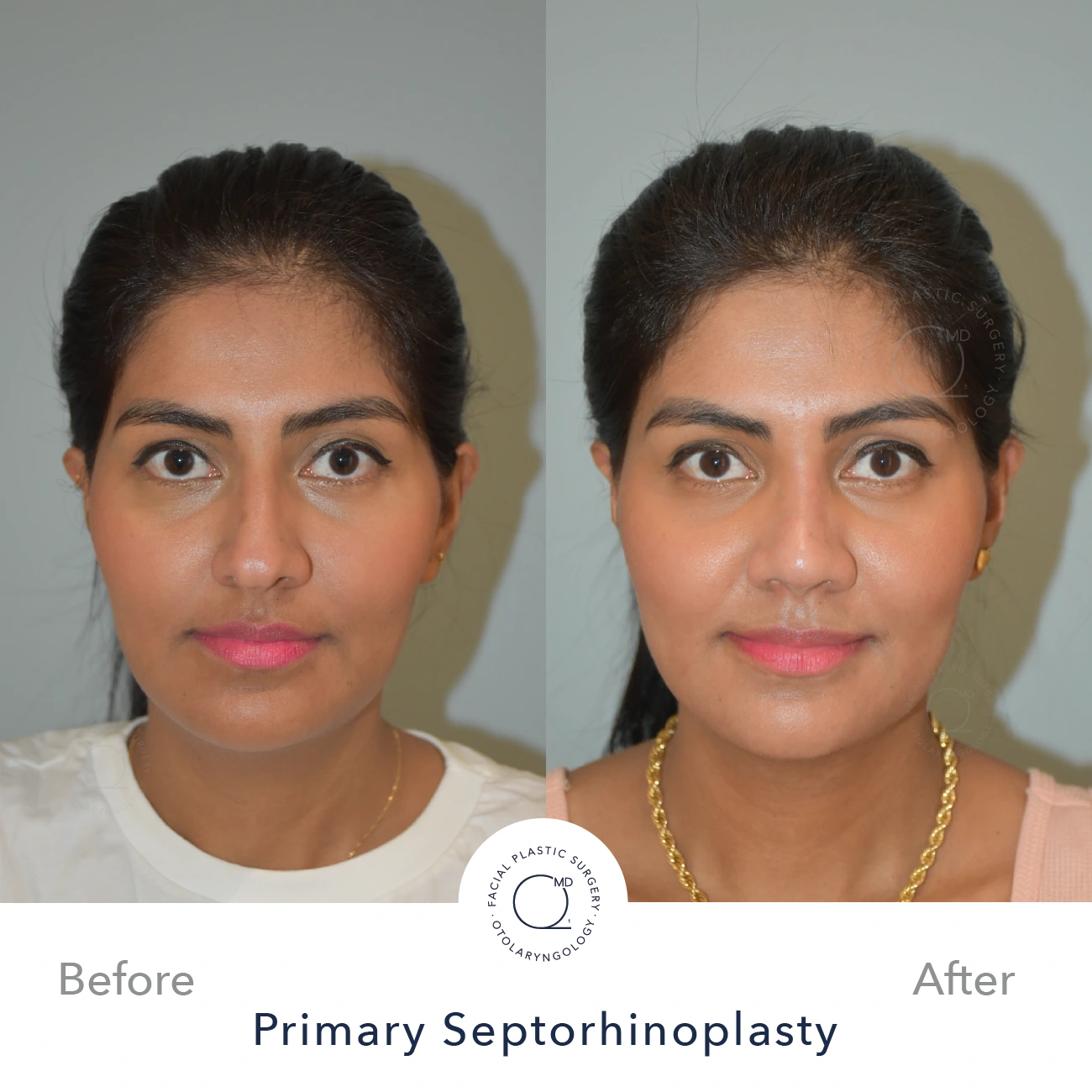 Rinoplastia Madrid perfil caso 23