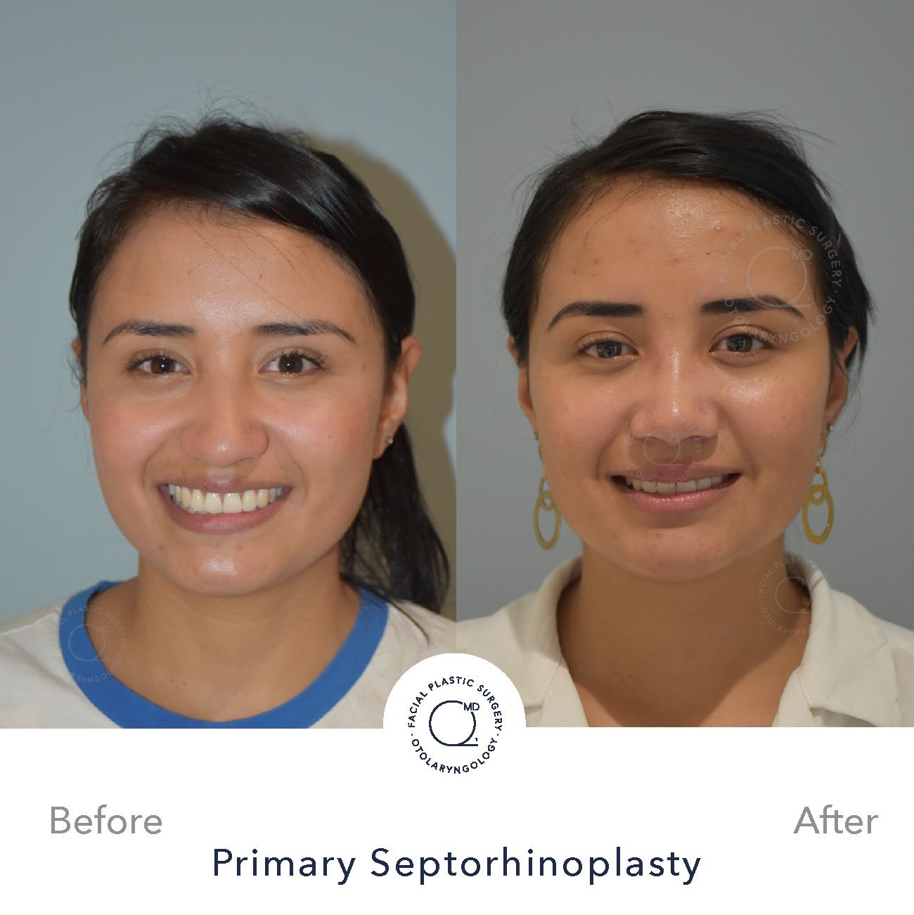 rinoplastia-foto-perfil-despues-caso-30