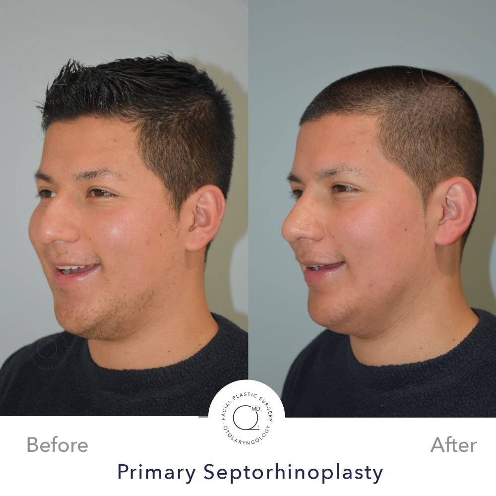 rinoplastia-foto-perfil-despues-caso-32