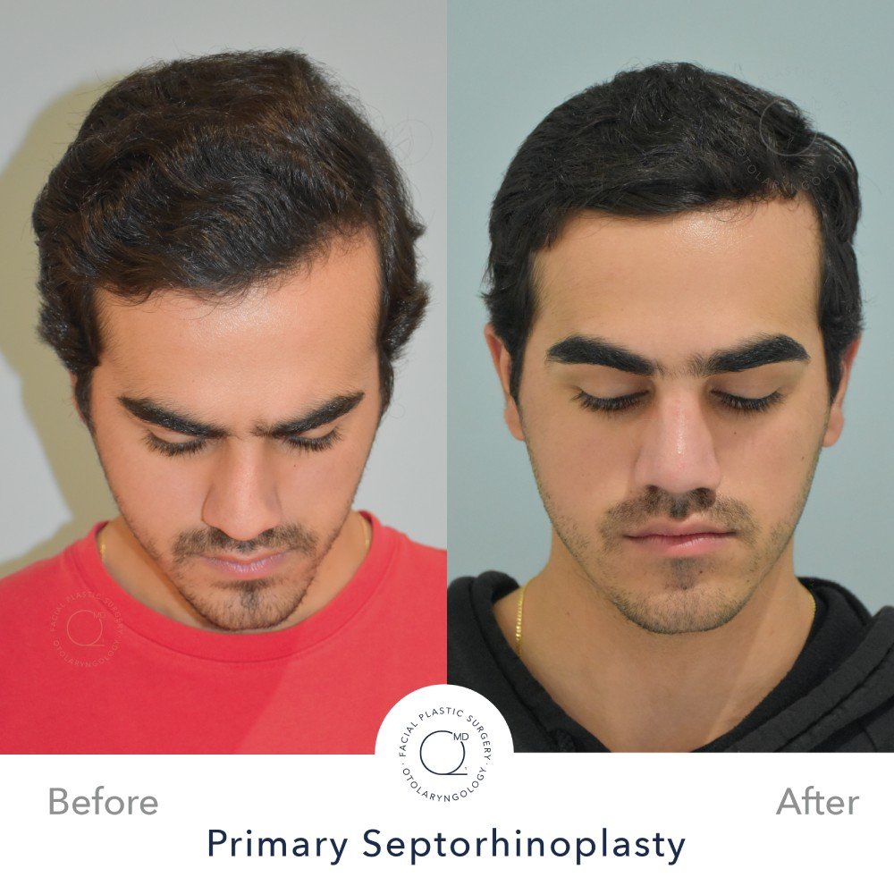 rinoplastia-foto-perfil-despues-caso-36