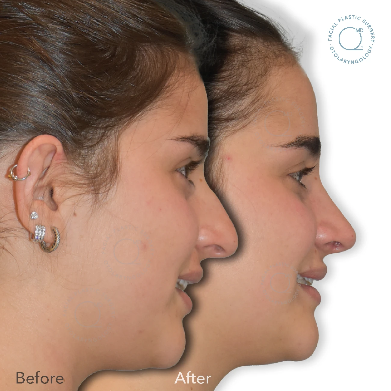 rinoplastia-madrid-caso27