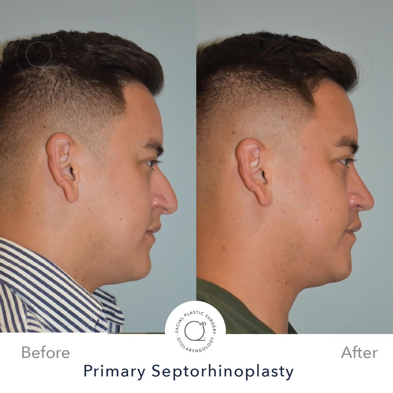 Rinoplastia Madrid foto antes caso 24