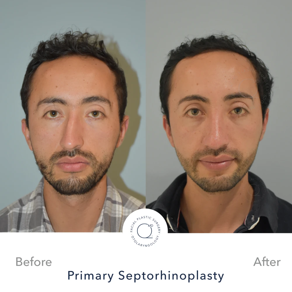 rinoplastia paciente perfil bajo caso 28
