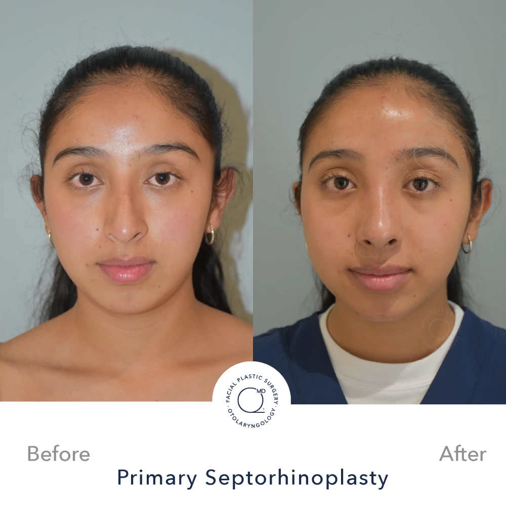 rinoplastia-paciente-perfil-bajo-caso-31