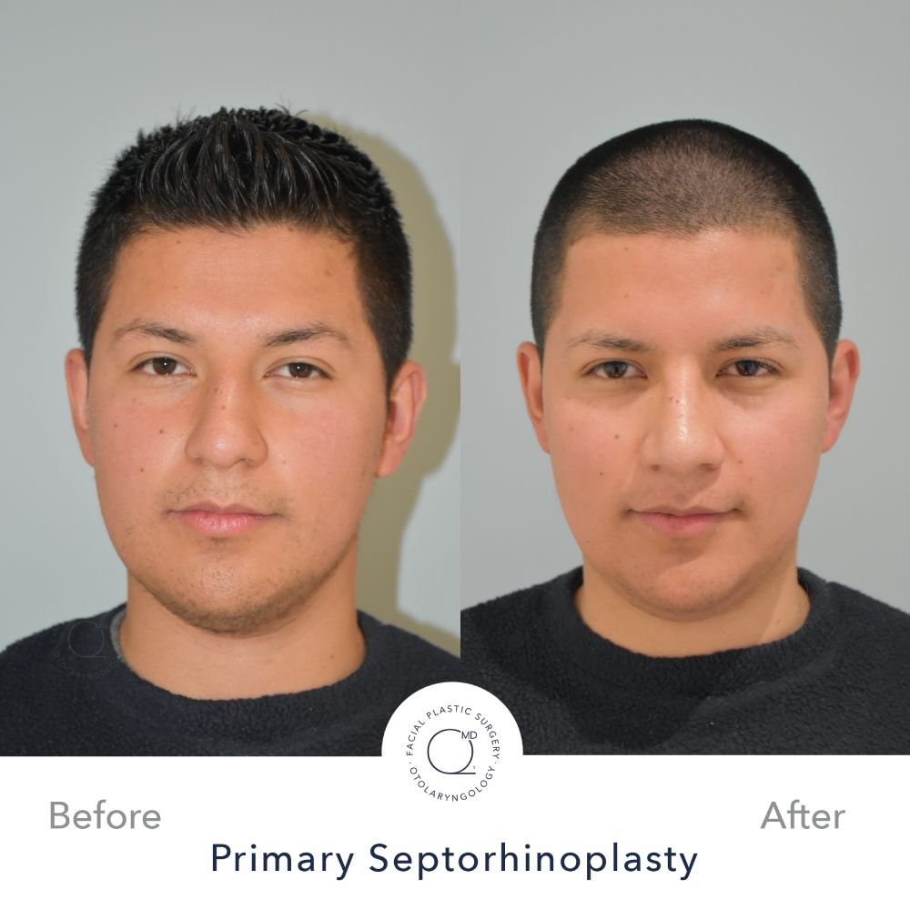 rinoplastia-paciente-perfil-bajo-caso-32